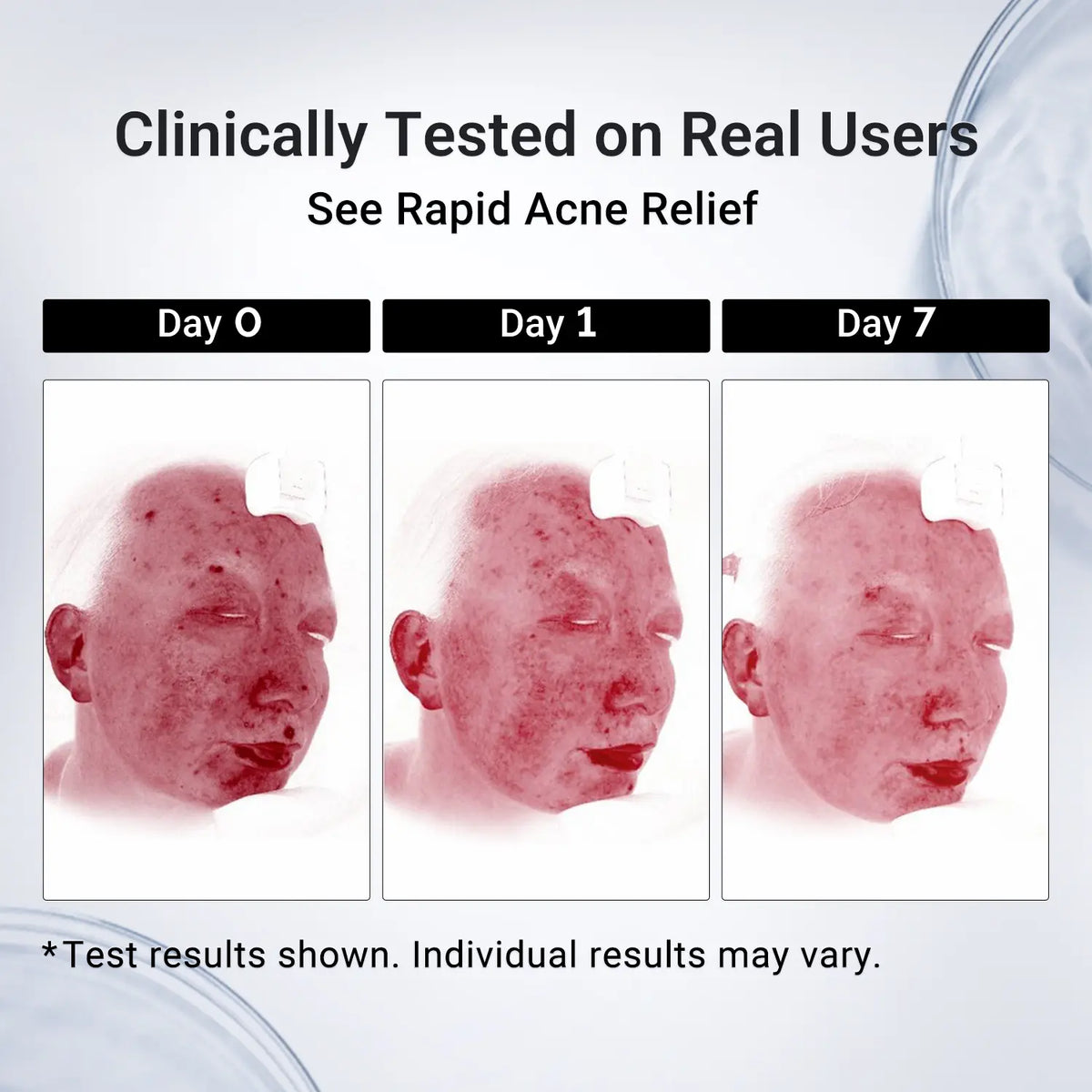 Evina™ AcneClear Drying Lotion